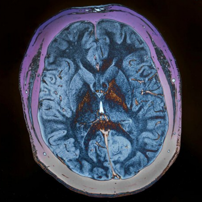 Image d'un scanner cérébral sur écran d'ordinateur